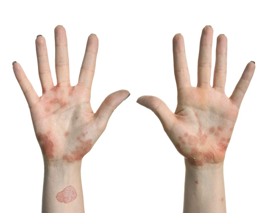 Psoriasis en las manos